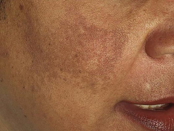 Melasma Myths: Debunking Common Misconceptions